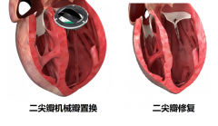 微创守护“心”希望!四川泰康医院成功实施高难度胸腔镜心脏瓣膜体外循环手